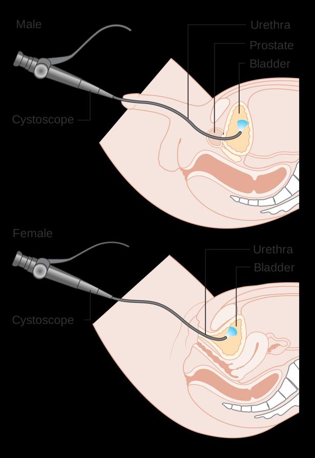 Flexible Cystoscopy Auckland | Ormiston Urology